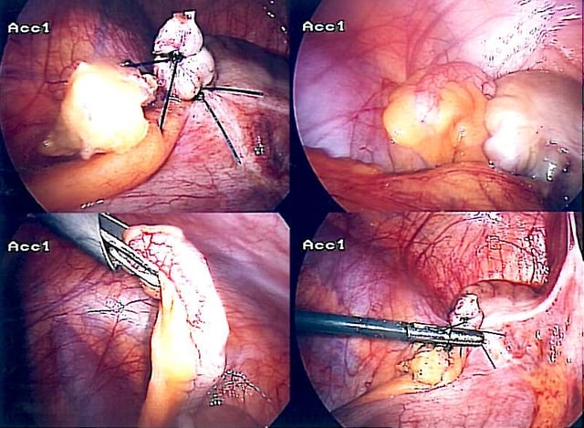 Laparoscopic appendectomy.