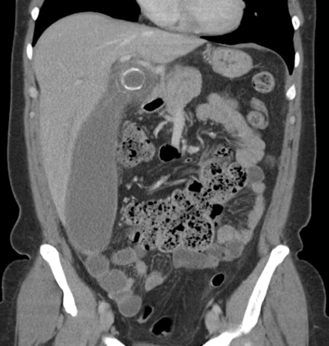 Coronal CT scan of a person initially suspected of having appendicitis because of right-sided pain. The CT shows in fact an enlarged inflamed gallbladder that reaches the right lower part of the abdomen.