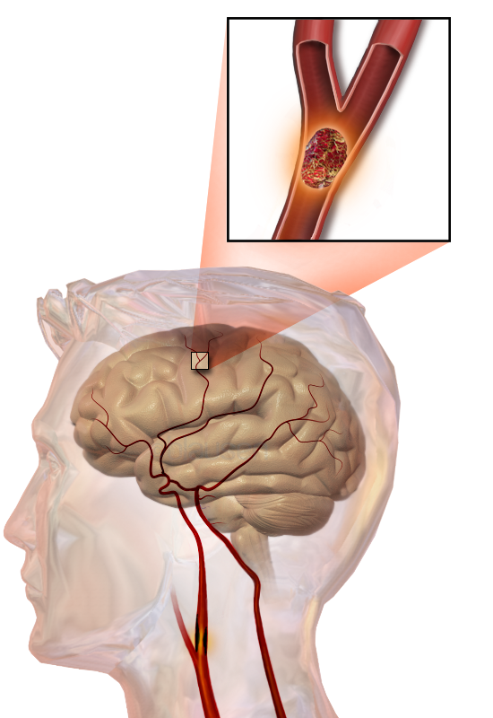 Illustration of an embolic stroke, showing a blockage lodged in a blood vessel.