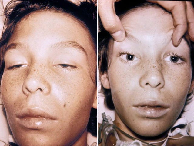 Neurotoxic ptosis caused by botulinum toxin: a 14-year-old botulism patient with bilateral total ophthalmoplegia with ptosis (left image) and dilated, fixed pupils (right image). The teenager was fully conscious
