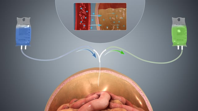 A depiction of peritoneal dialysis.