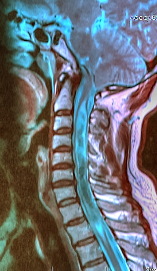 Syringomyelia associated with Chiari malformation