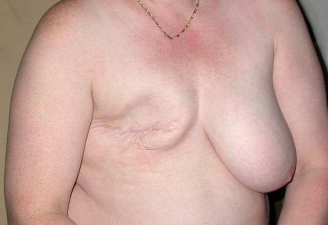 Chest after right breast mastectomy