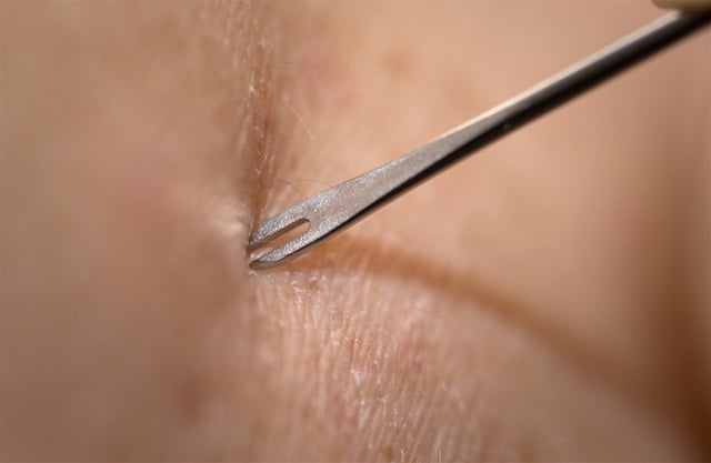 A demonstration by medical personnel on use of a bifurcated needle to deliver the smallpox vaccine, 2002.