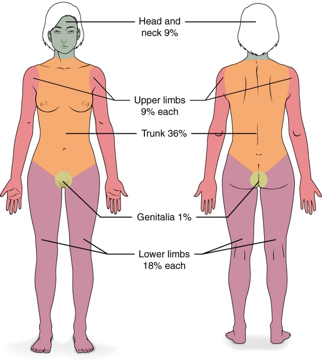 Burn severity is determined through, among other things, the size of the skin affected.
