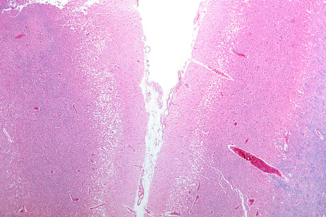 Micrograph showing cortical pseudolaminar necrosis, a finding seen in strokes on medical imaging and at autopsy. H&E-LFB stain.