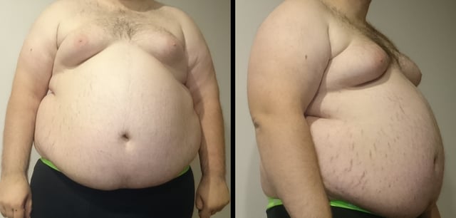 A "super obese" male with a BMI of 53 kg/m2: weight 182 kg (400 lb), height 185 cm (6 ft 1 in). He presents with stretch marks and enlarged breasts