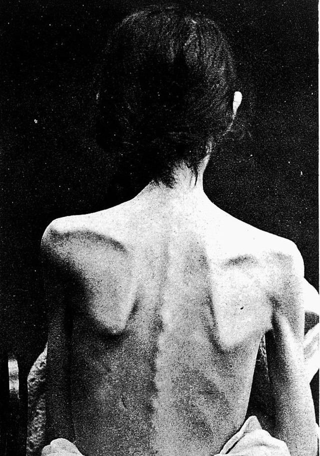 The back of a person with anorexia