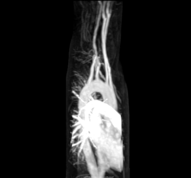 Magnetic resonance angiography of aberrant subclavian artery