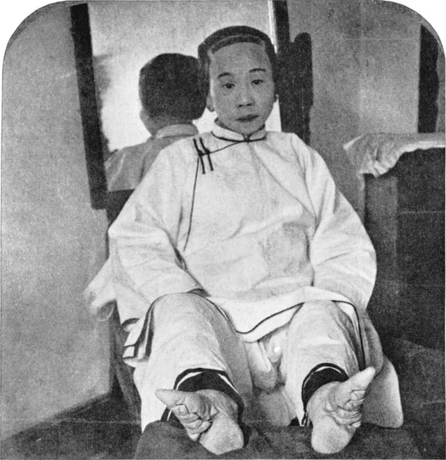 Chinese woman shows the effect of foot binding