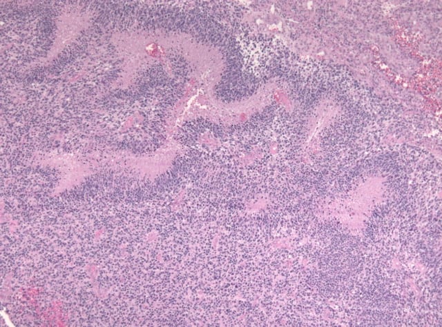 Pseudopalisades seen around necroses in glioblastoma.