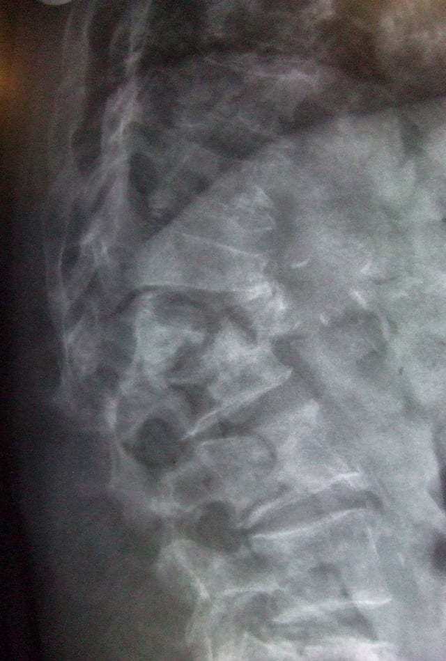 Multiple osteoporotic wedge fractures demonstrated on a lateral thoraco-lumbar spine X-ray