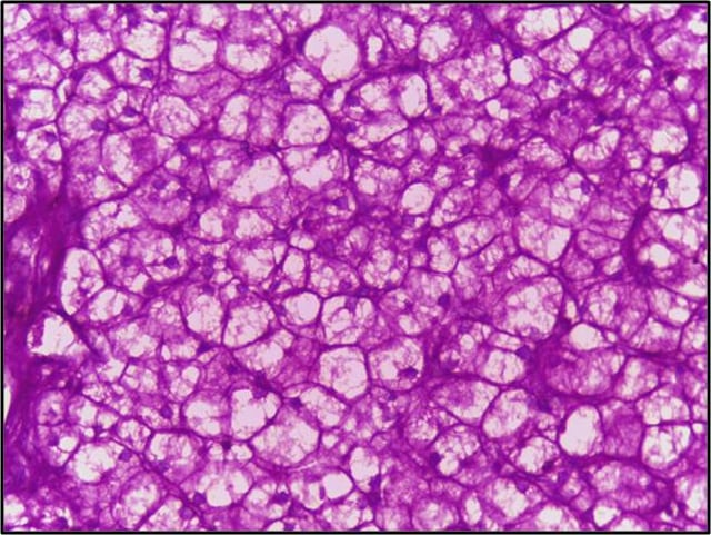 Liver in glycogen storage disease, PAS stain