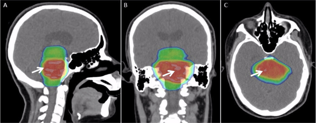 Radiation therapy for a patient with a diffuse intrinsic pontine glioma, with radiation dose color-coded.