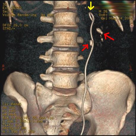 Three-dimensional reconstructed CT scan image of a ureteral stent in the left kidney (indicated by yellow arrow), with a kidney stone in the inferior renal pelvis (highest red arrow) and one in the ureter beside the stent (lower red arrow)