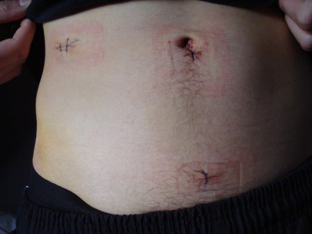 The stitches the day after having the appendix removed by laparoscopic surgery