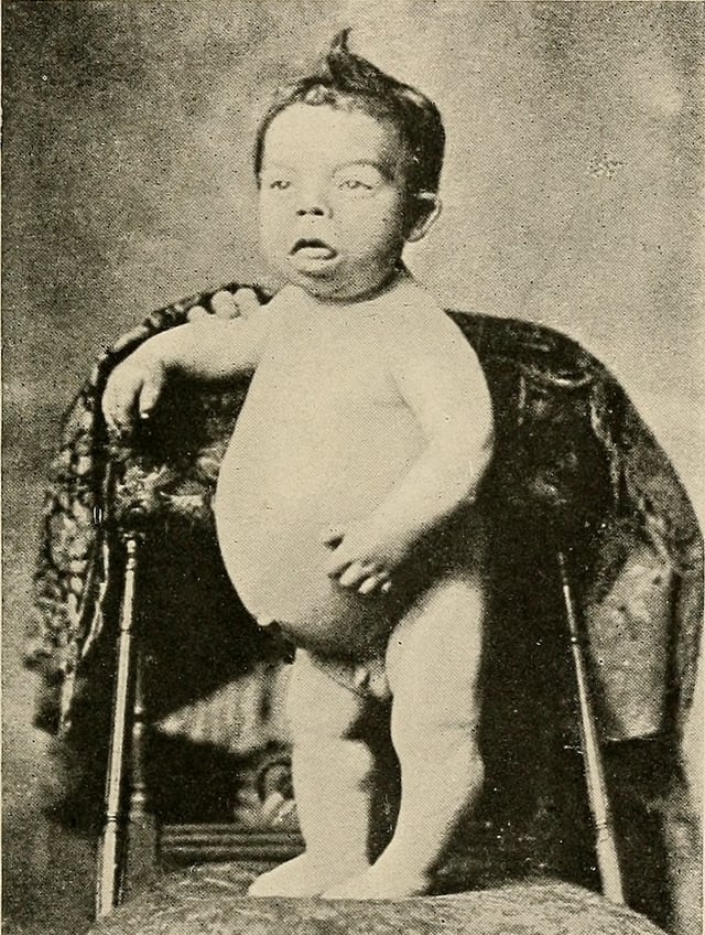 Child affected by cretinism, associated with a lack of iodine.