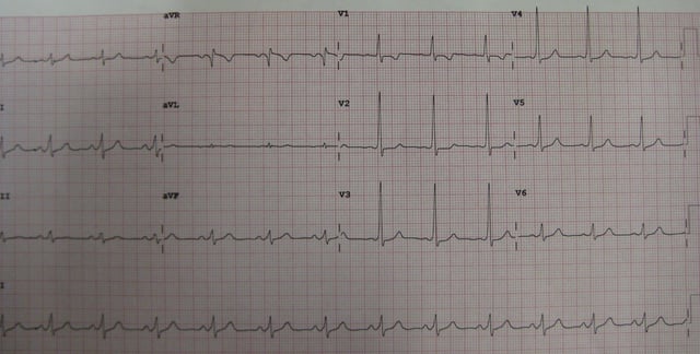 12 lead electrocardiogram of an individual with Wolff–Parkinson–White syndrome