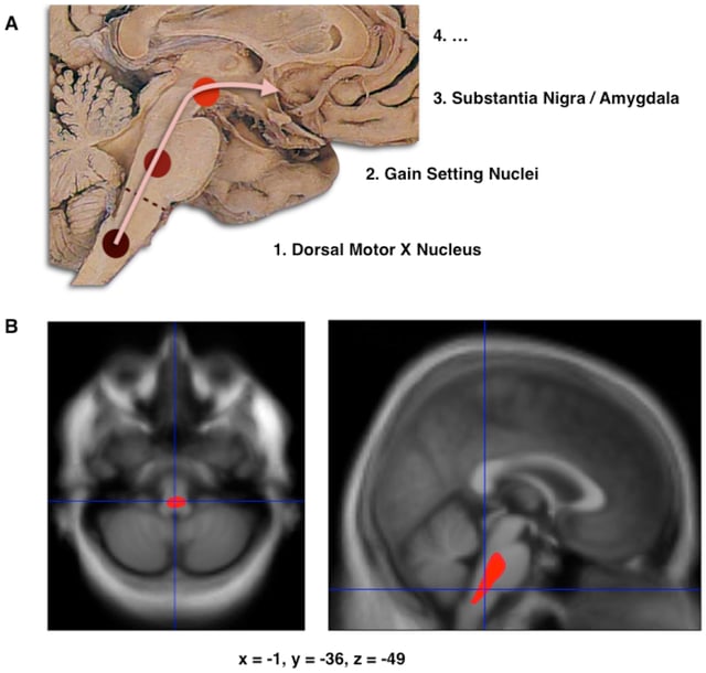 Schematic initial progression of Lewy body deposits in the first stages of Parkinson's disease, as proposed by Braak and colleaguesLocalization of the area of significant brain volume reduction in initial PD compared with a group of participants without the disease in a neuroimaging study, which concluded that brainstem damage may be the first identifiable stage of PD neuropathology