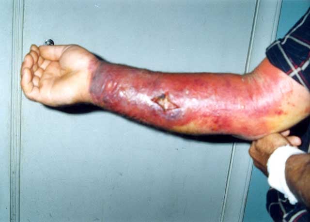 Skin lesion from anthrax