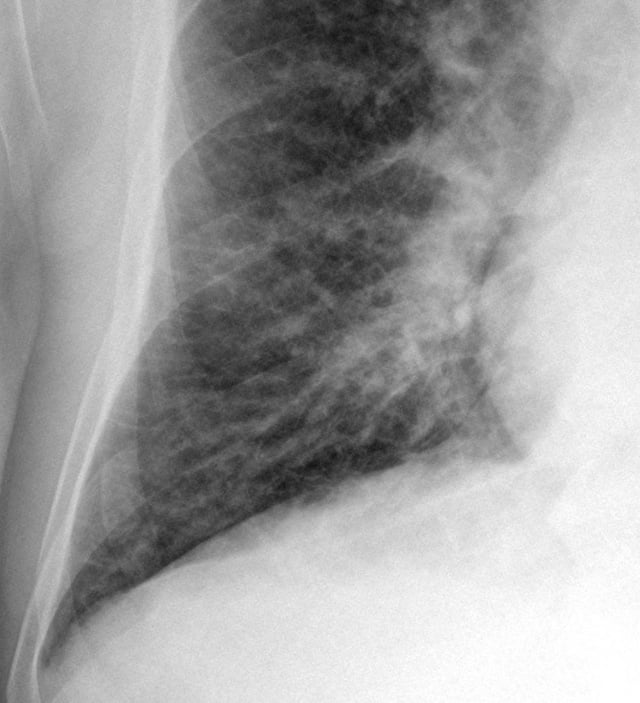 Kerley B lines in acute cardiac decompensation.