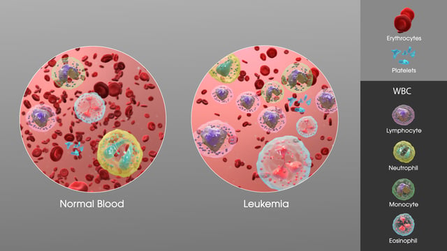 The increase in white blood cells in leukemia.