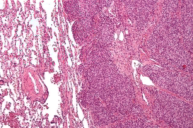 Micrograph of a metastatic Ewing's sarcoma with the characteristic cytoplasmic clearing on H&E staining, which was showing to be PAS positive.