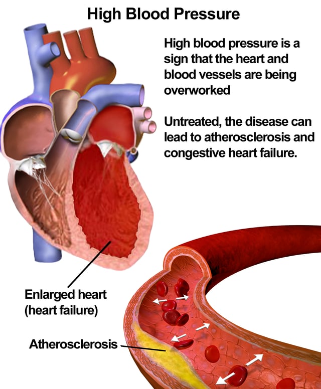 Illustration depicting the effects of high blood pressure