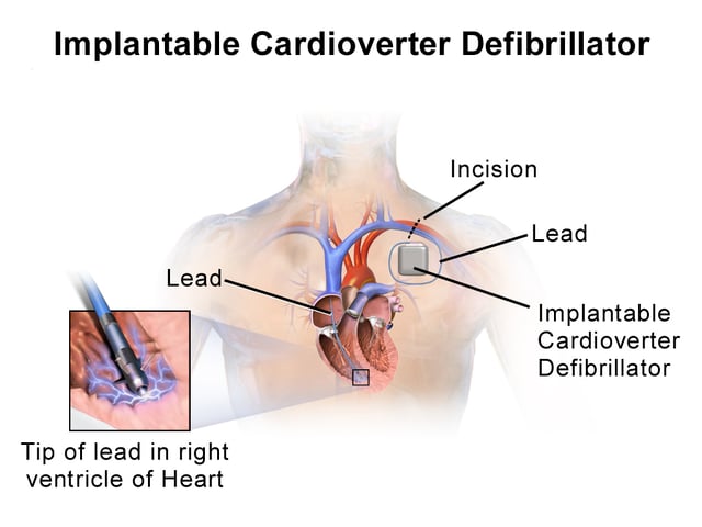 Illustration of implantable cardioverter defibrillator (ICD)