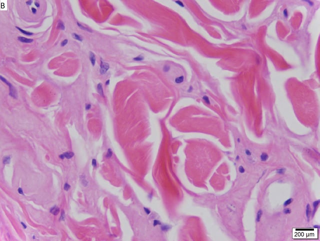 Urbach–Wiethe disease in skin biopsy with H&E stain.