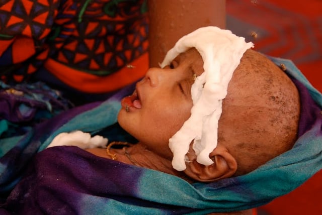 A Somali boy receiving treatment for malnourishment at a health facility.