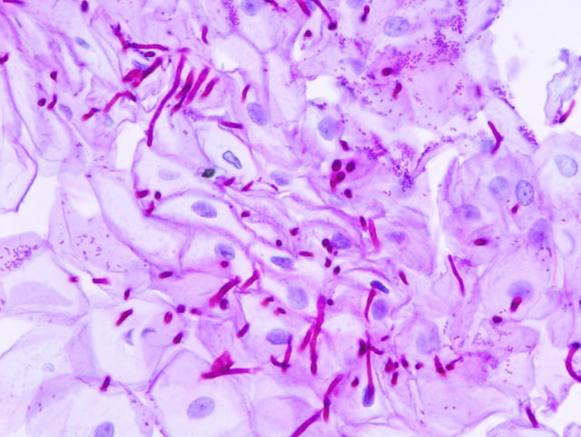 Esophageal candidiasis, PAS stain