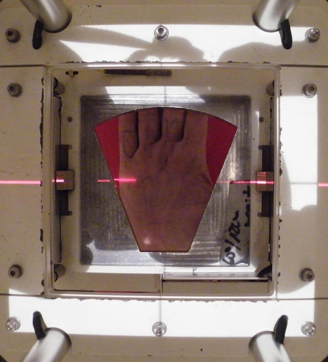 The beam's eye view of the radiotherapy portal on the hand's surface with the lead shield cut-out placed in the machine's gantry