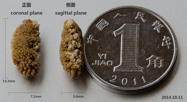 A lenticular kidney stone, excreted in the urine
