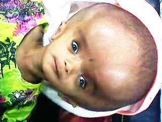 A one-year-old girl with hydrocephalus showing "sunset eyes", before shunt surgery