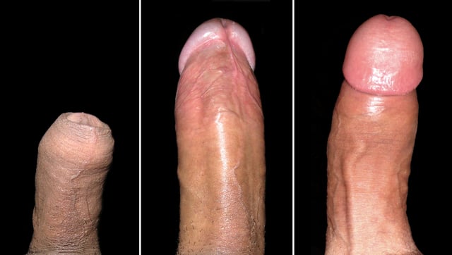 A ventral view of a penis flaccid (left) and erect (middle); a dorsal view of a penis erect (right).