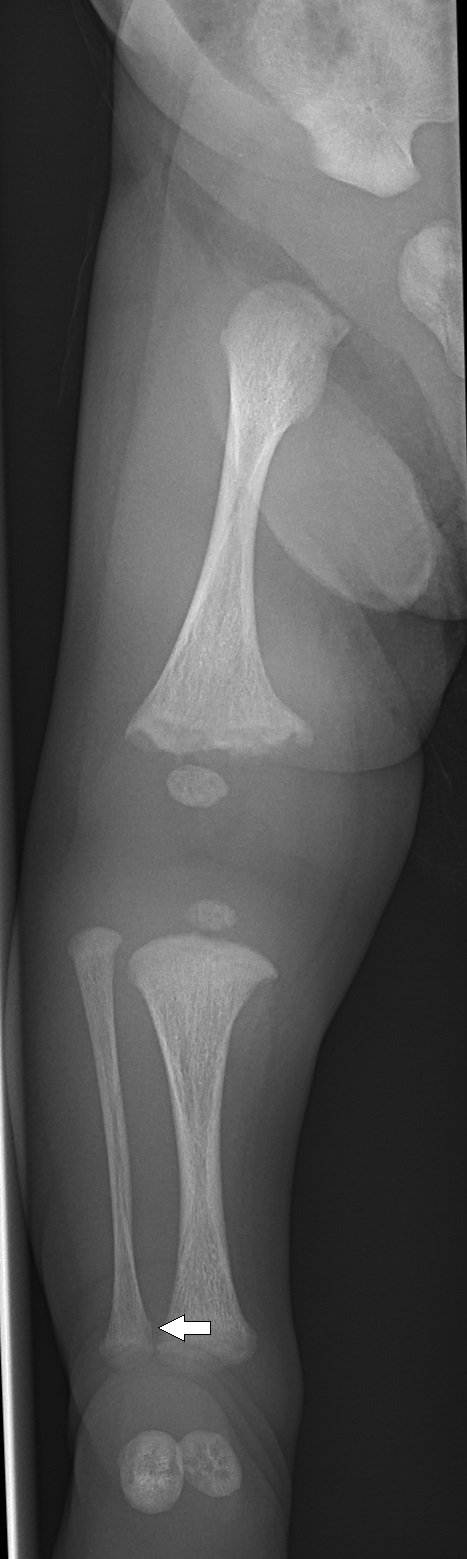 X-ray of the right leg in a newborn with OI type V. There are somewhat deformed long bones (mainly the femur) with widened metaphyses. There's a cortical fracture of the fibula.