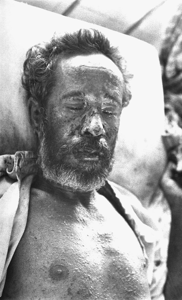 A man with severe hemorrhagic-type smallpox. (Bangladesh, 1975)