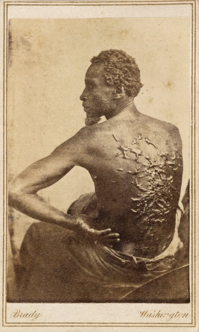 Medical examination photo of Gordon, widely distributed by Abolitionists to expose the brutality of slavery