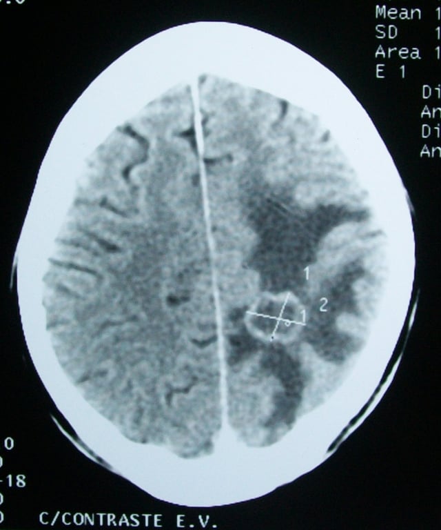 CT scan of a brain tumor, with its diameters marked as an X. There is hypoattenuating (dark) peritumoral edema in the surrounding white matter, with a "finger-like" spread.