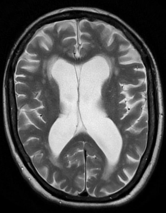 Hydrocephalus ex vacuo from vascular dementia as seen on MRI