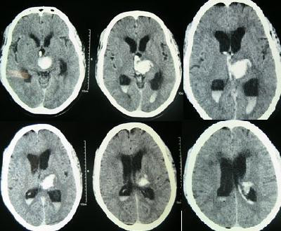 Spontaneous intracerebral and intraventricular hemorrhage with hydrocephalus shown on CT scan