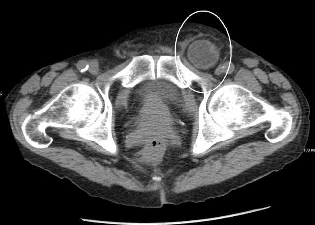 An incarcerated inguinal hernia as seen on CT