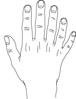 Postaxial polydactyly