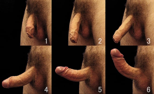 The development of a penile erection, also showing the foreskin gradually retracting over the glans. Commons image gallery