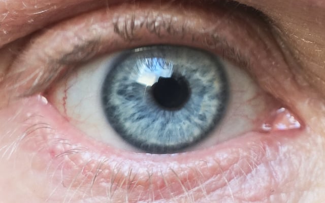 A light blue iris with limbal ring