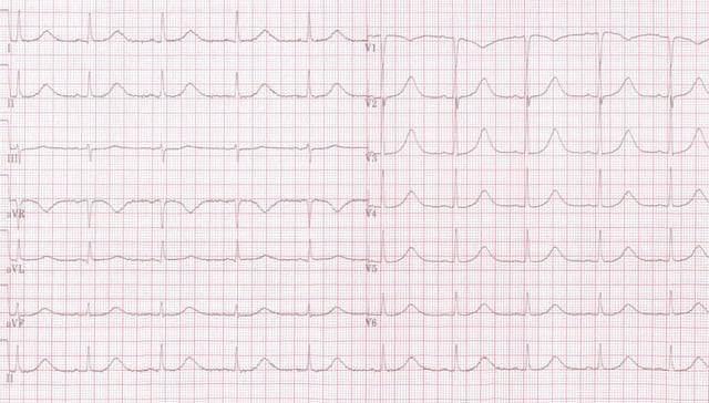 Acquired long QT syndrome
