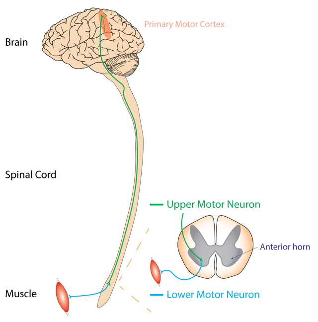 Typical or "classical" ALS involves neurons in the brain (upper motor neurons) and in the spinal cord (lower motor neurons).