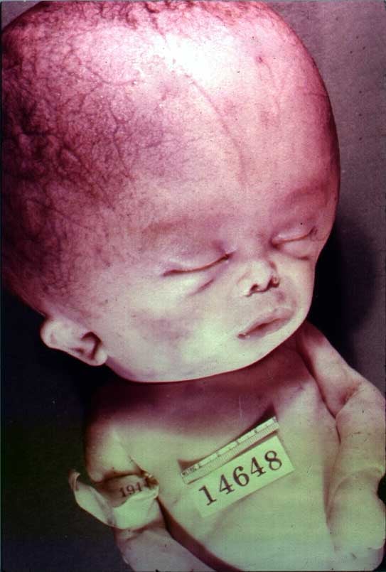 Historical specimen of an infant with severe hydrocephalus, probably untreated