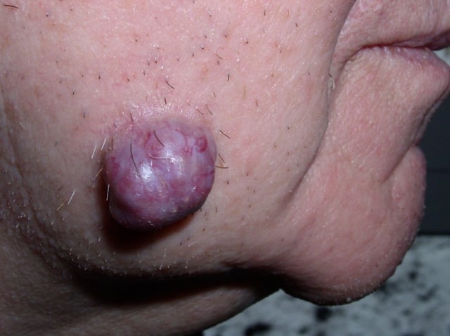 Neoplastic tumor of the cheek skin, here a benign neoplasm of the sweat glands called hidradenoma, which is not solid but is fluid-filled